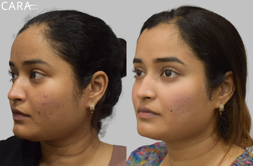 before and after image of female acne and scar treatment image