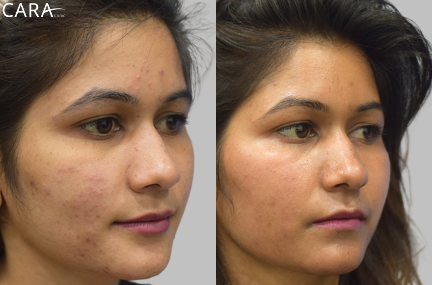 before and after image of female pigmentation treatment image