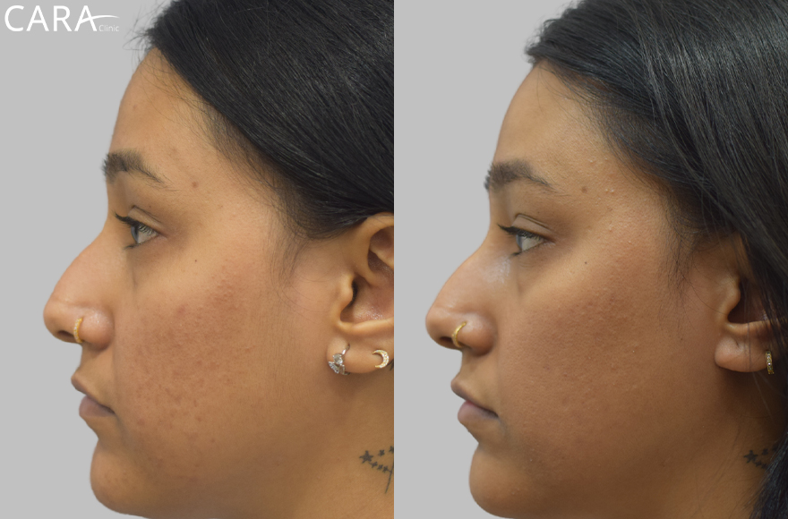 Side-by-side comparison showcasing the transformation in a patient's skin after acne and acne scar treatment. The 'before' image reveals acne scars and uneven skin texture, while the 'after' image shows smoother, clearer skin with significantly reduced scarring.