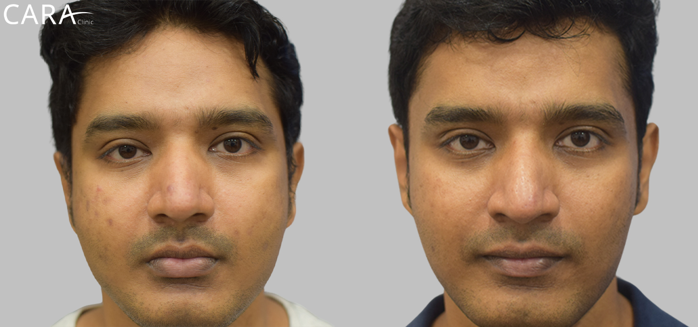 Side-by-side comparison of the patient's skin before and after anti-pigmentation treatment. The 'before' image shows noticeable dark spots and uneven skin tone, while the 'after' image reveals brighter, more even-toned skin with reduced pigmentation.