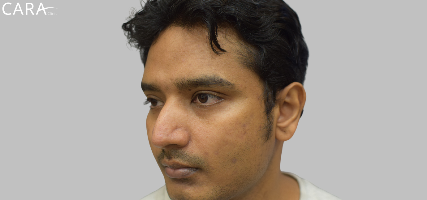 Close-up of the patient's skin before treatment, highlighting dark patches, hyperpigmentation, and uneven skin tone across the face.