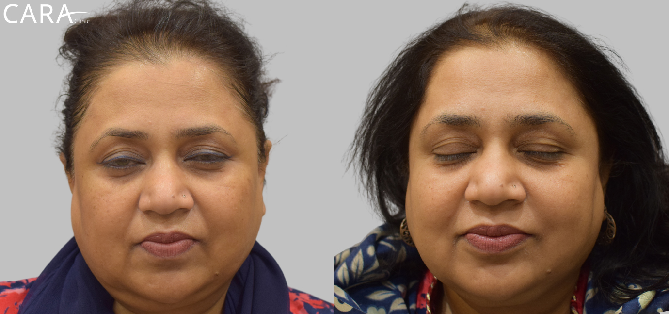 Side-by-side comparison of the patient's skin before and after anti-pigmentation treatment. The 'before' image shows noticeable dark spots and uneven skin tone, while the 'after' image reveals brighter, more even-toned skin with reduced pigmentation.