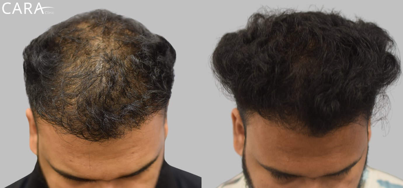 Before and after image of male hair loss treatment showing significant hair restoration results after FUE hair transplant at Cara Clinic.