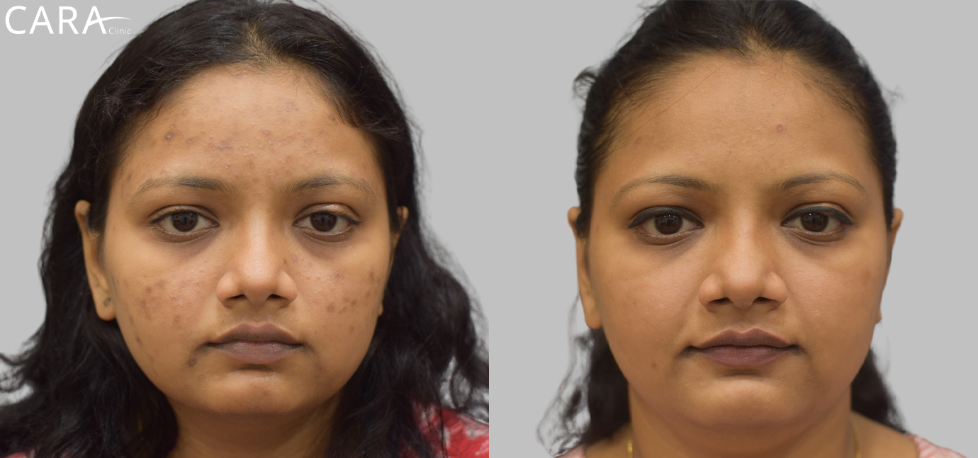 Side-by-side comparison of the patient's skin before and after anti-pigmentation treatment. The 'before' image shows noticeable dark spots and uneven skin tone, while the 'after' image reveals brighter, more even-toned skin with reduced pigmentation.