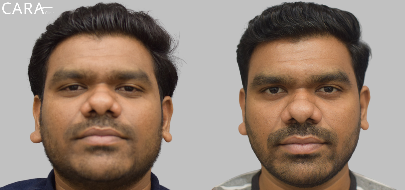 Side-by-side comparison of the patient's skin before and after anti-pigmentation treatment. The 'before' image shows noticeable dark spots and uneven skin tone, while the 'after' image reveals brighter, more even-toned skin with reduced pigmentation.