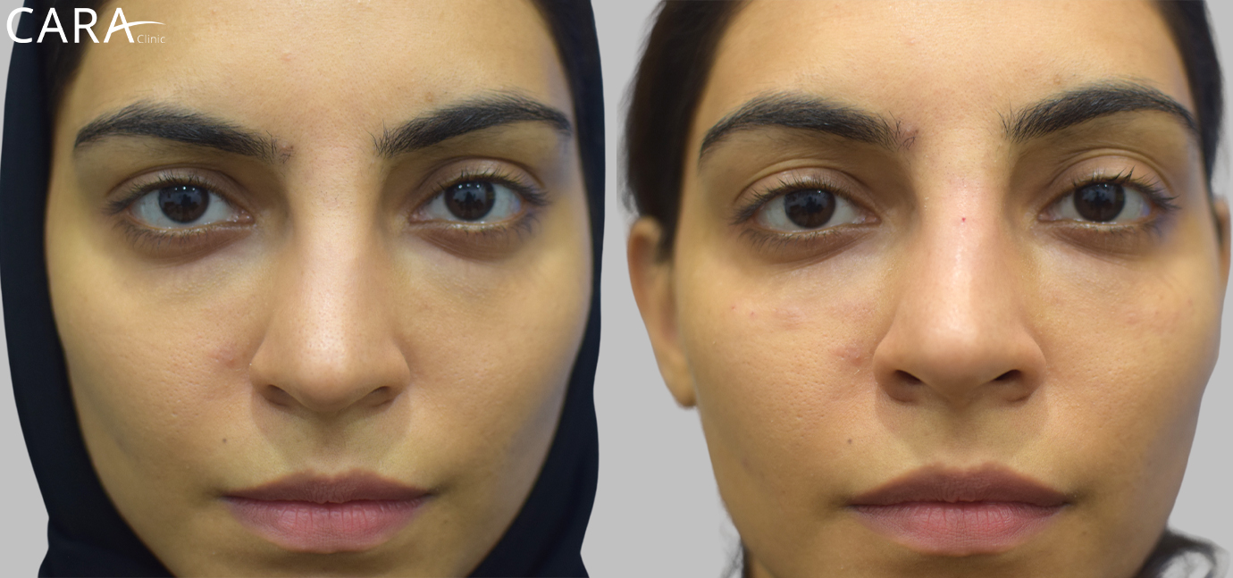 Comparison of the undereye area before and after tear trough treatment. The 'before' image shows noticeable hollowness, while the 'after' image reveals fuller, rejuvenated undereye contours, creating a more youthful and refreshed appearance.