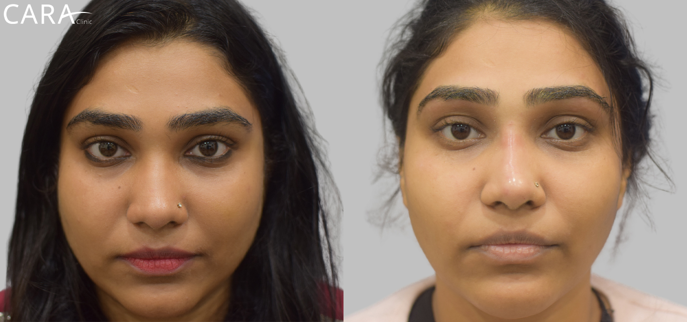 Comparison of a woman's face before and after a non-surgical facelift and masseter reduction. The 'before' image shows a fuller, rounder face, while the 'after' image highlights a slimmer, more contoured facial structure with defined cheekbones and jawline.