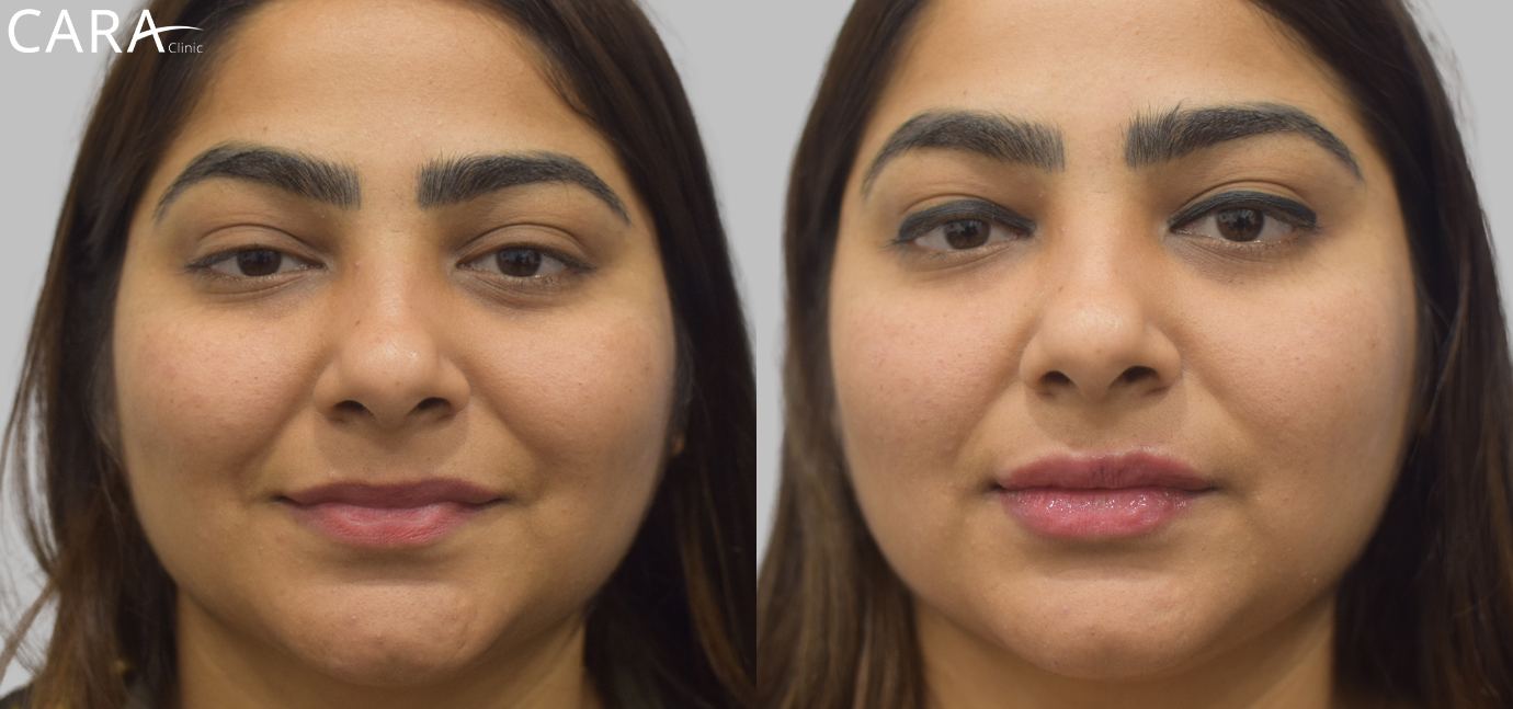 A side-by-side comparison showing the transformation of thin, asymmetrical lips into fuller, symmetrical lips after lip filler treatment. The "before" image displays less volume, while the "after" image reveals enhanced lips with balanced proportions.