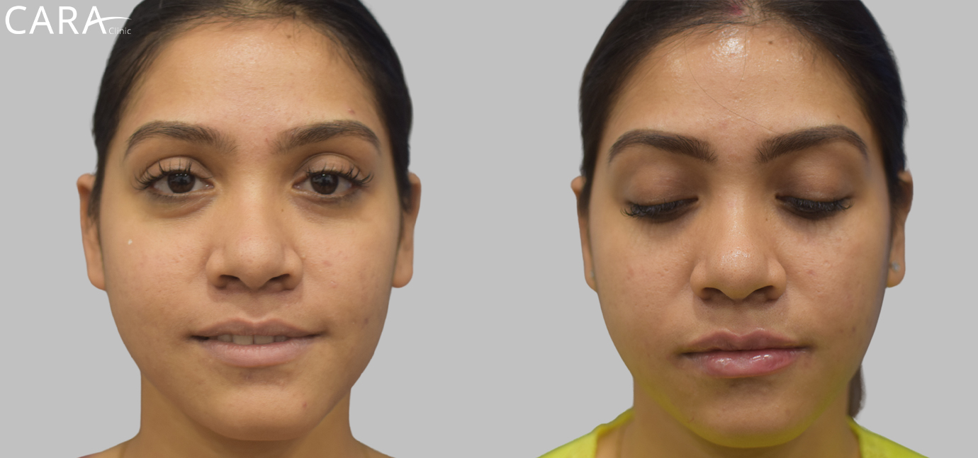 A side-by-side comparison highlighting the transformation of lips before and after dermal filler treatment. The "before" image shows thin, less defined lips, while the "after" image reveals fuller, symmetrical, and well-shaped lips, enhancing the overall facial appearance.