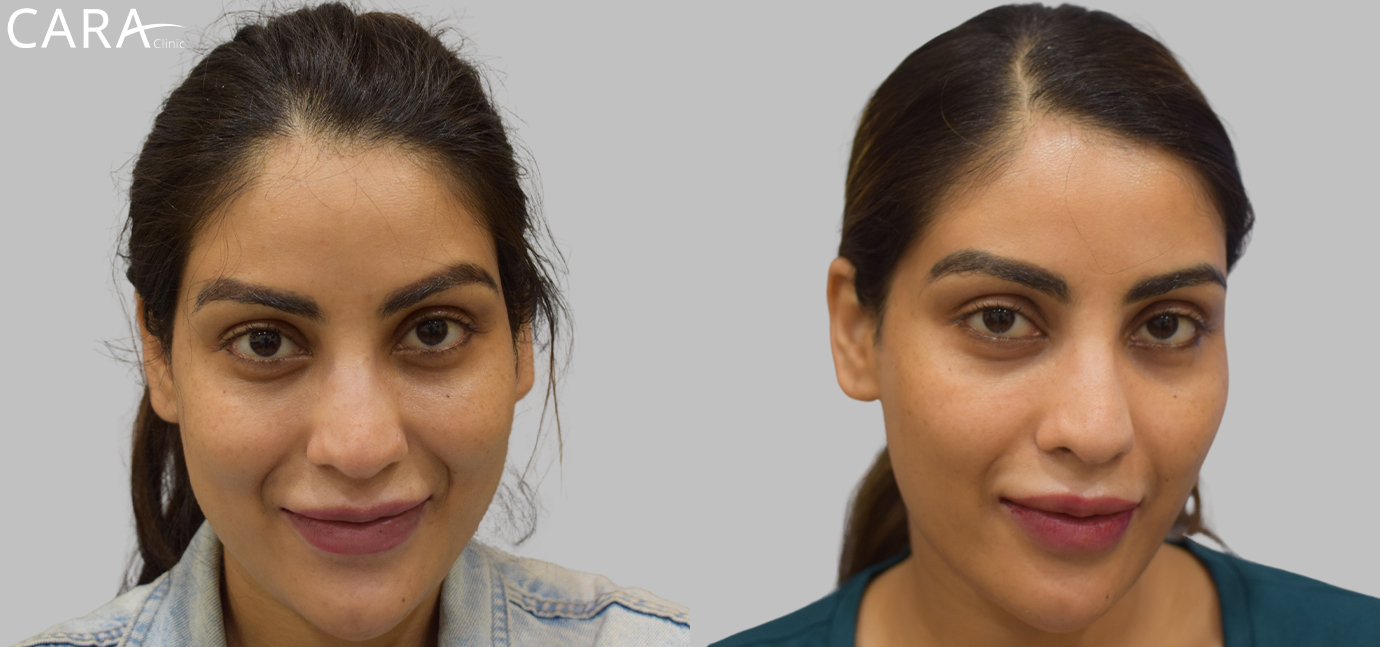 A side-by-side comparison showing the transformation of both the jawline and lips after dermal filler treatment. The "before" image depicts a softer jawline and thinner lips, while the "after" image reveals a more defined jawline and fuller, symmetrical lips.