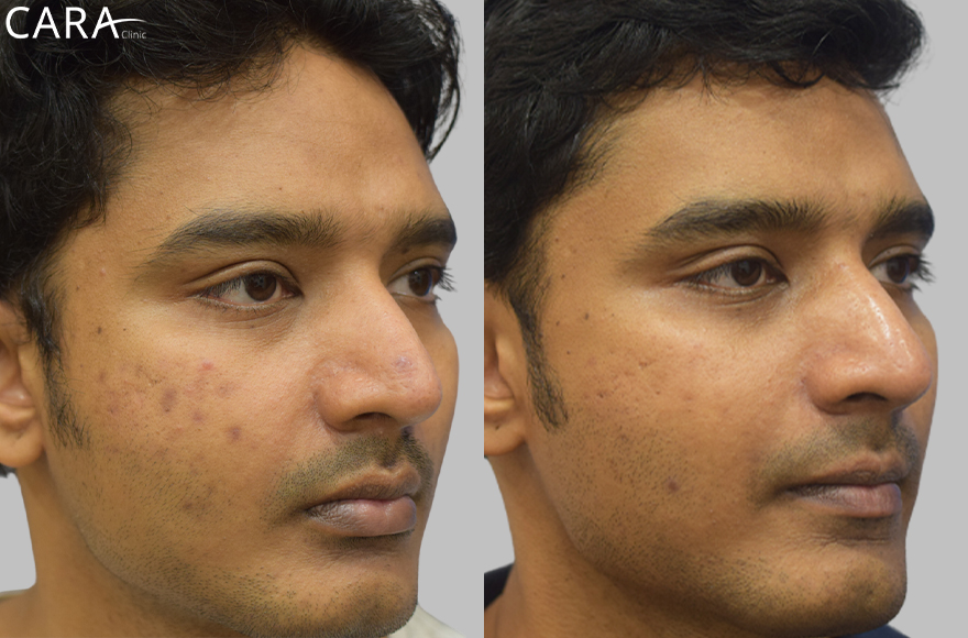 before and after image of male pigmentation treatment image