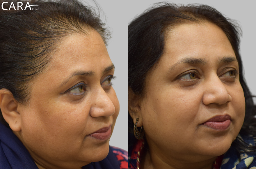 before and after image of female pigmentation treatment image