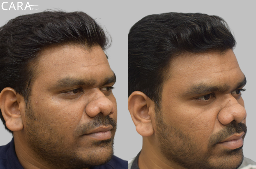 before and after image of male pigmentation treatment image