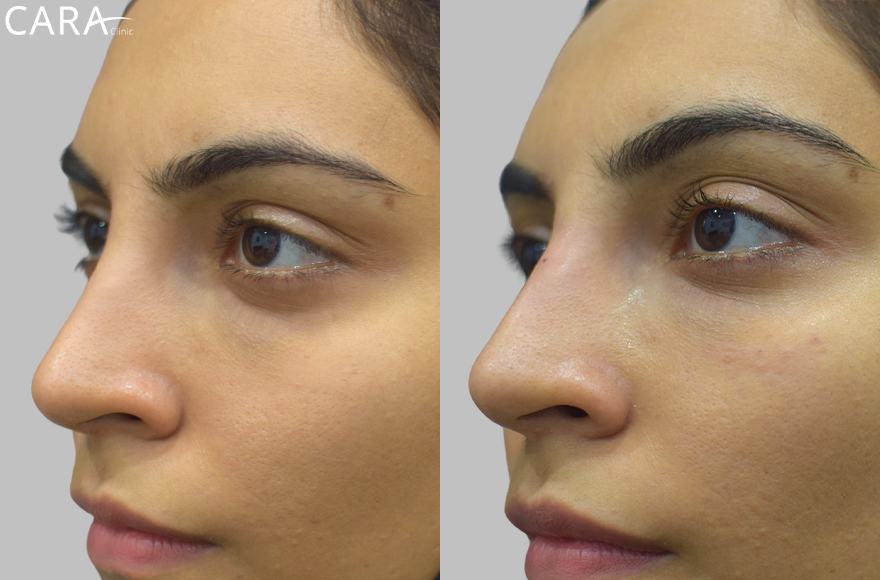 Comparison of Aisha Siddique's undereye area before and after tear trough treatment. The 'before' image shows noticeable hollowness, while the 'after' image reveals fuller, rejuvenated undereye contours, creating a more youthful and refreshed appearance.