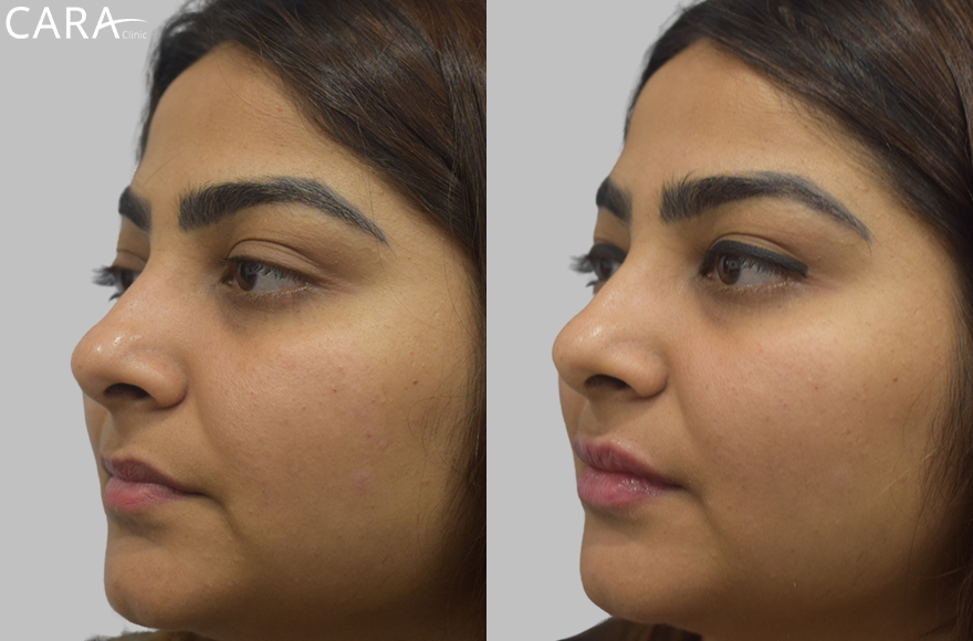 before and after image of female lip filler treatment image