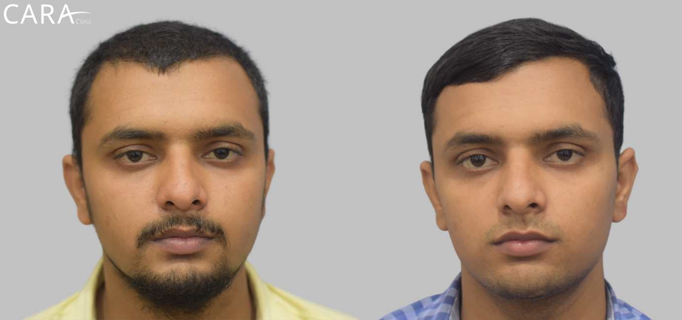 Before and after image of male hair loss treatment showing significant hair restoration results after FUE hair transplant at Cara Clinic.