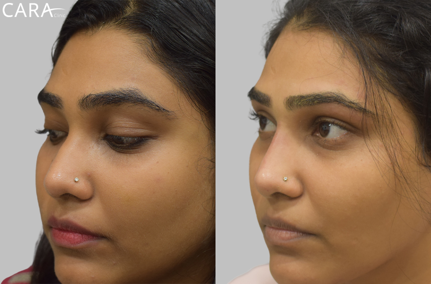 before and after image of female anti ageing treatment image