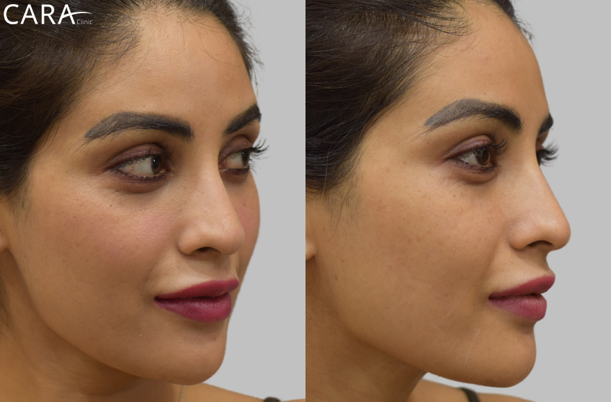 before and after image of female anti ageing treatment image