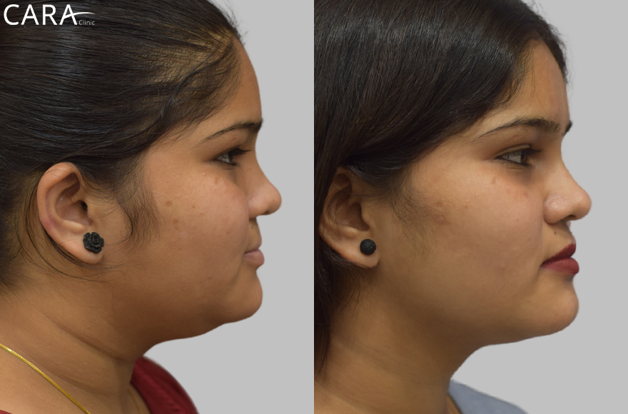 before and after image of female lip filler treatment image