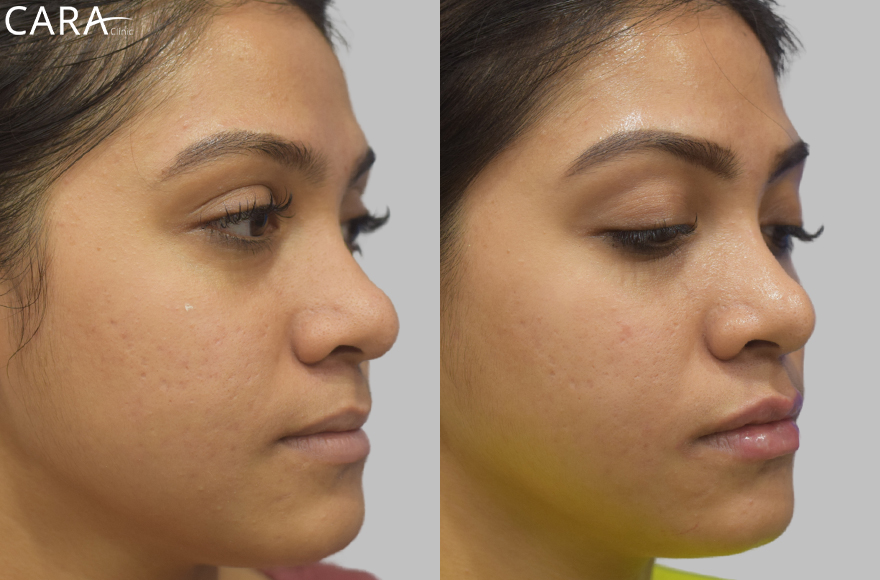 before and after image of female anti ageing treatment image