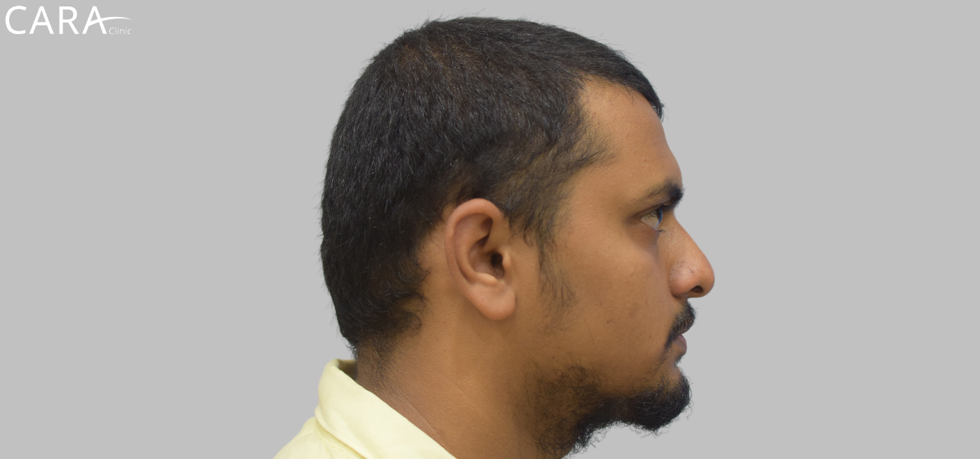 Before Male Hair Loss Treatment: "Male patient showing signs of hair thinning and receding hairline before hair loss treatment at Cara Clinic."