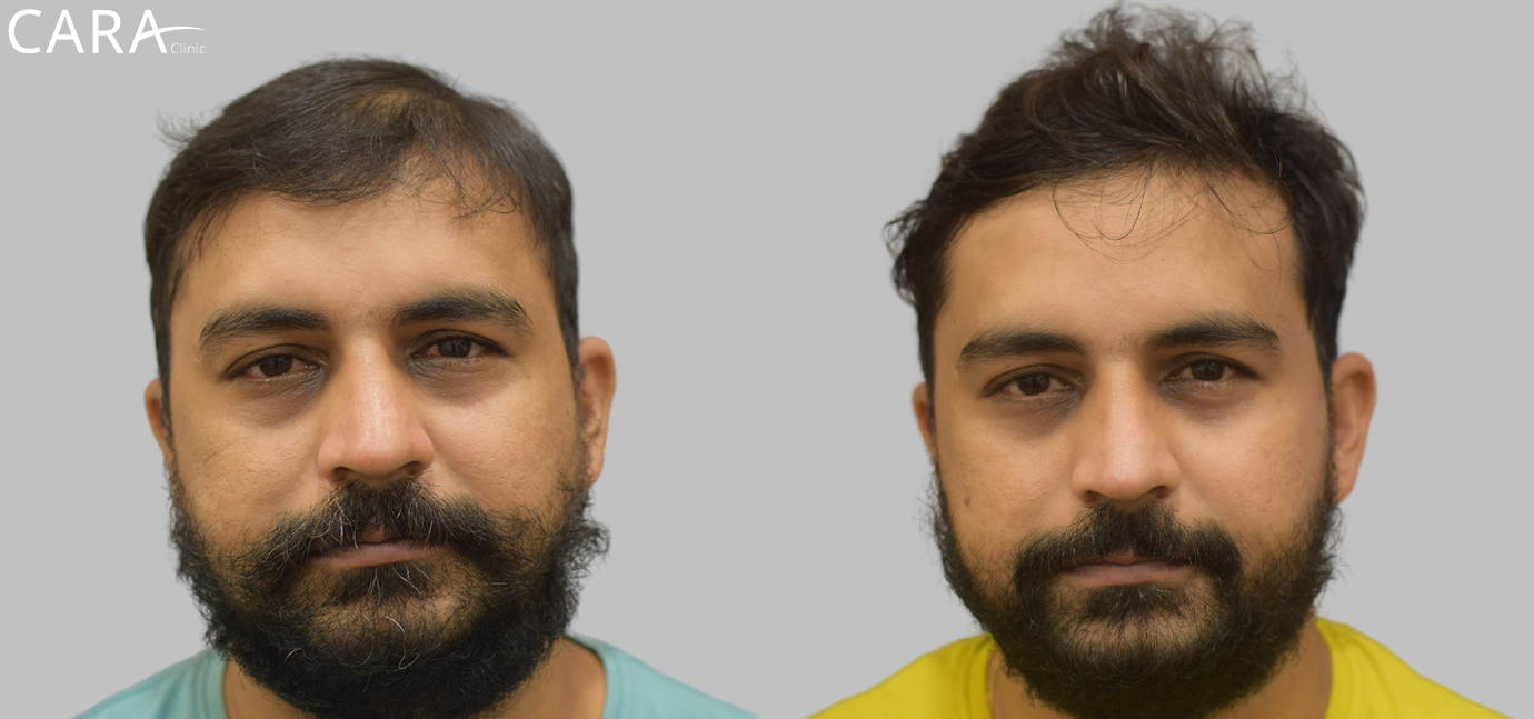 Before and after image of male hair loss treatment showing significant hair restoration results after FUE hair transplant at Cara Clinic.