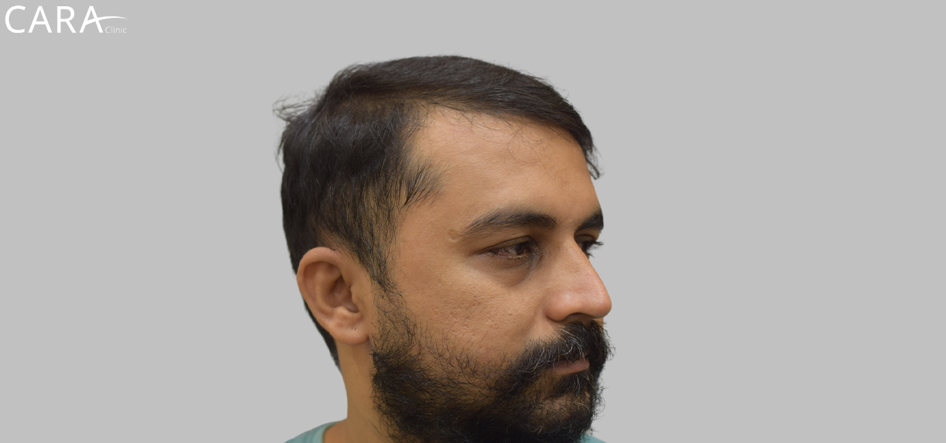 Before Male Hair Loss Treatment: "Male patient showing signs of hair thinning and receding hairline before hair loss treatment at Cara Clinic."