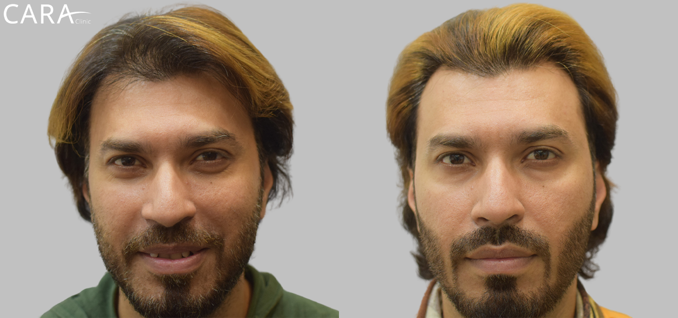 "Before and after image of male hair loss treatment showing significant hair restoration results after FUE hair transplant at Cara Clinic."