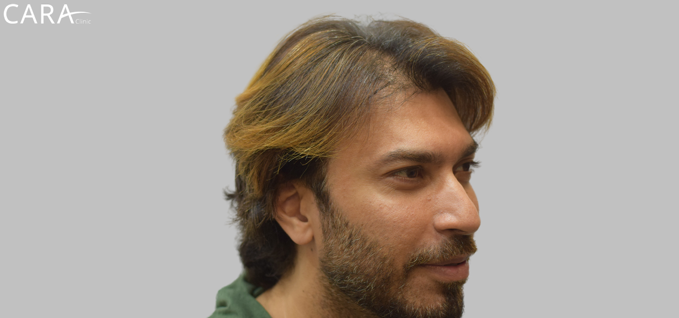 Before Male Hair Loss Treatment: "Male patient showing signs of hair thinning and receding hairline before hair loss treatment at Cara Clinic."