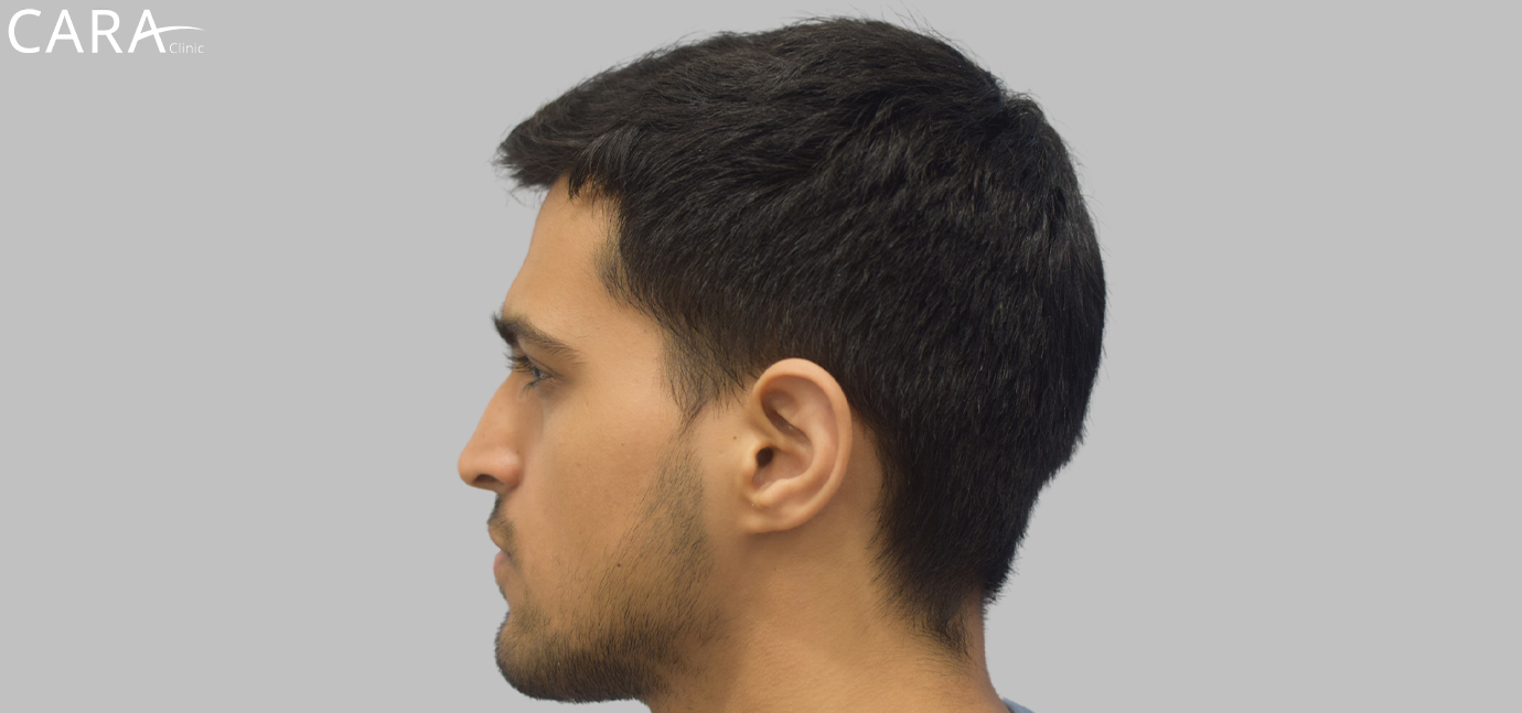 Before Male Hair Loss Treatment: "Male patient showing signs of hair thinning and receding hairline before hair loss treatment at Cara Clinic."