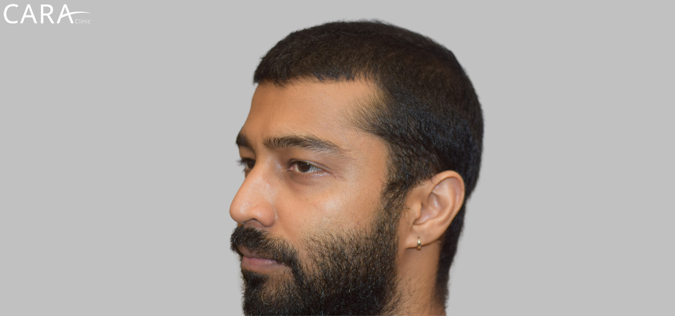 Before Male Hair Loss Treatment: "Male patient showing signs of hair thinning and receding hairline before hair loss treatment at Cara Clinic."