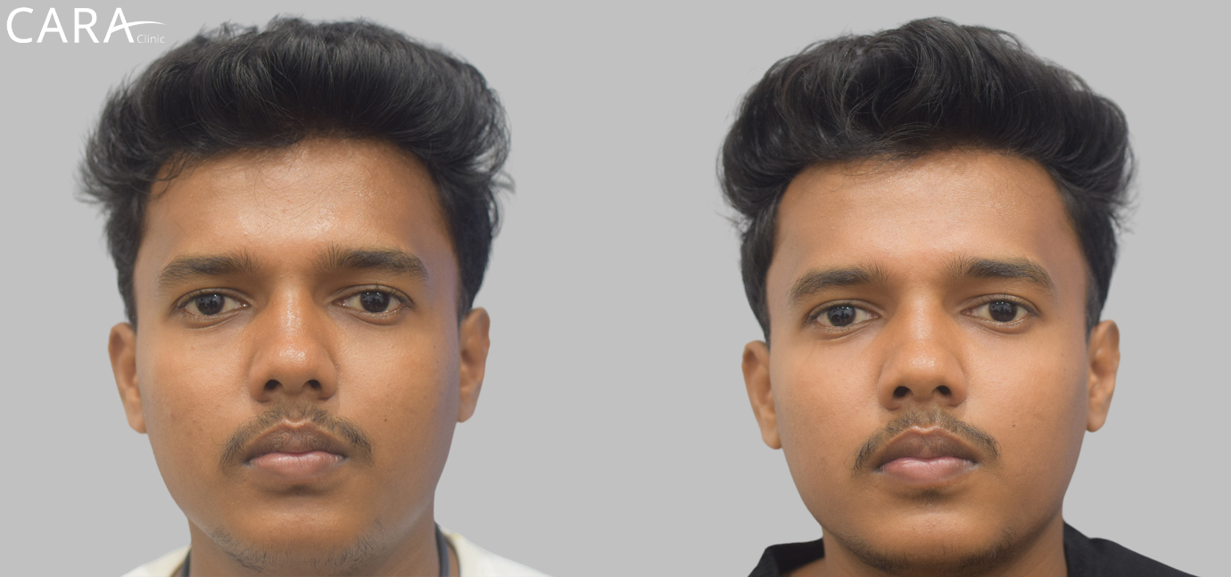 Before and after image of male hair loss treatment showing significant hair restoration results after FUE hair transplant at Cara Clinic.