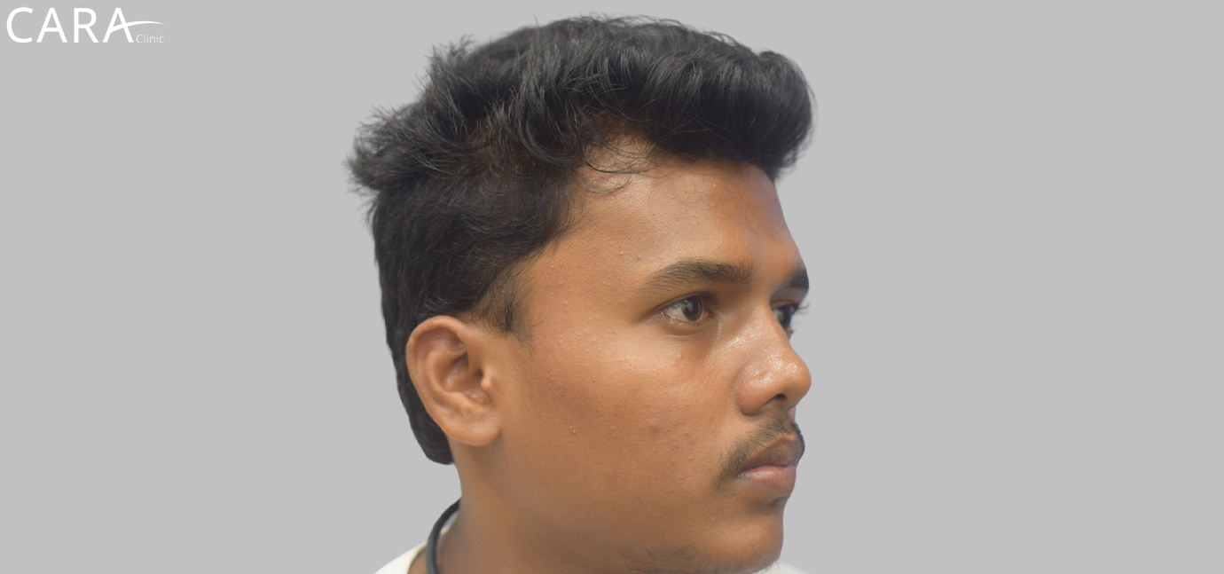 Before Male Hair Loss Treatment: "Male patient showing signs of hair thinning and receding hairline before hair loss treatment at Cara Clinic."