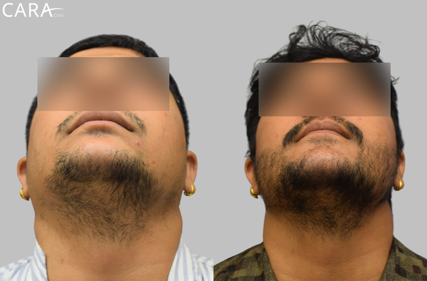 This is the banner image for Beard Hair Transplant treatment, featuring a man with a fuller and well-shaped beard