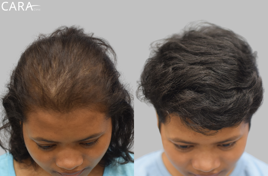 A banner showcasing a comparison of a female patient's scalp before and after hair loss treatment. The after image highlights significant hair regrowth and increased density, demonstrating the success of the treatment.