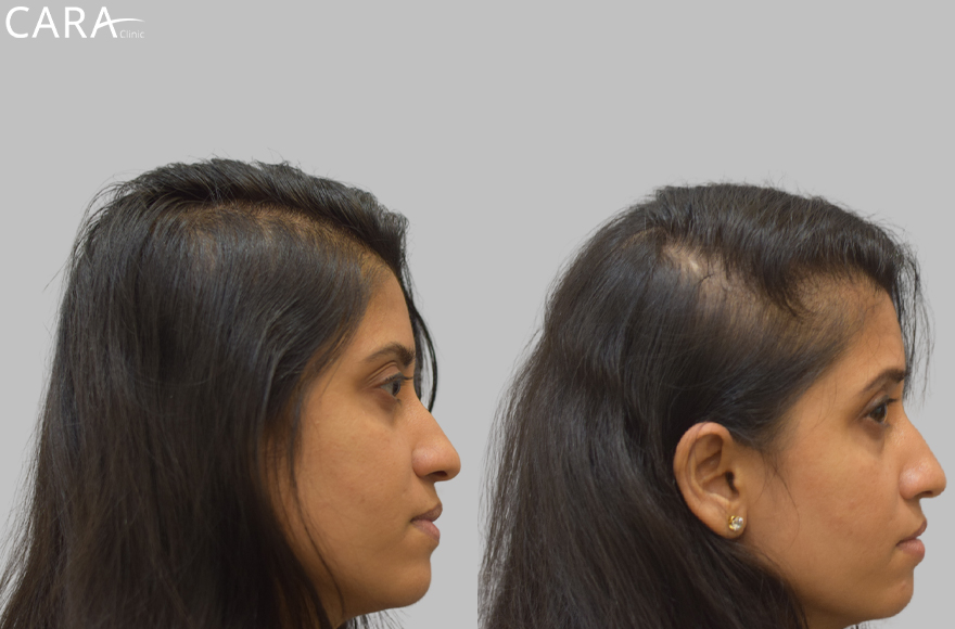 A banner showcasing a comparison of a female patient's scalp before and after hair loss treatment. The after image highlights significant hair regrowth and increased density, demonstrating the success of the treatment.