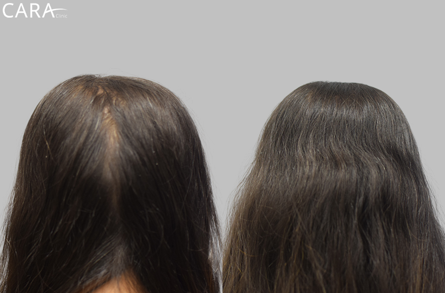 A banner showcasing a comparison of a female patient's scalp before and after hair loss treatment. The after image highlights significant hair regrowth and increased density, demonstrating the success of the treatment.