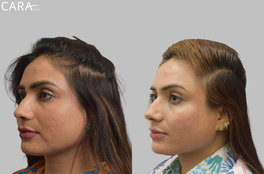 A banner showcasing a comparison of a female patient's scalp before and after hair loss treatment. The after image highlights significant hair regrowth and increased density, demonstrating the success of the treatment.