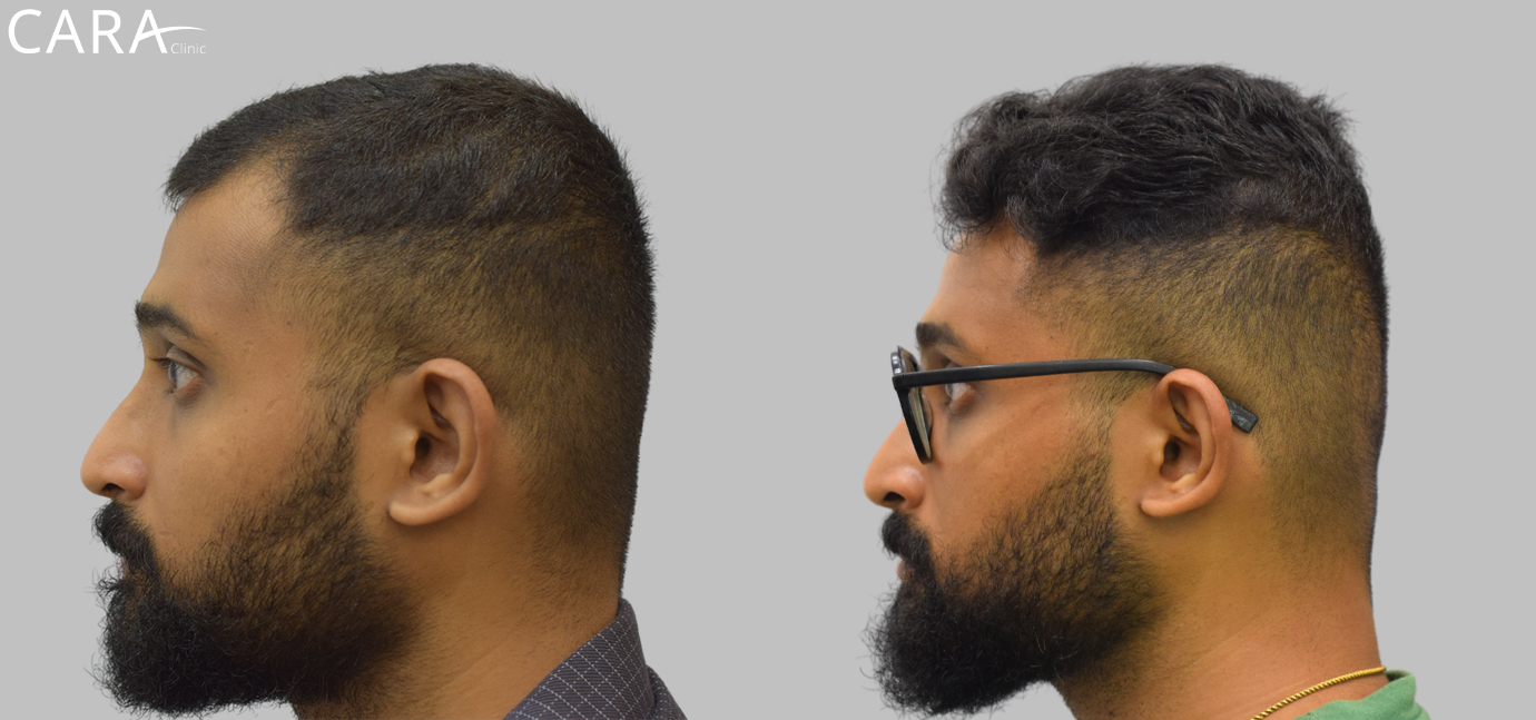 Before and after results of hairline transplant showing natural hair growth restoration using advanced FUE technique at Cara Clinic.