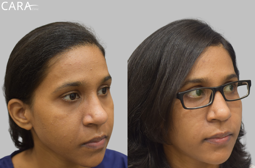 Before and after banner image of a female hair transplant showing significant improvement from thinning hair to a fuller, natural-looking hairline.