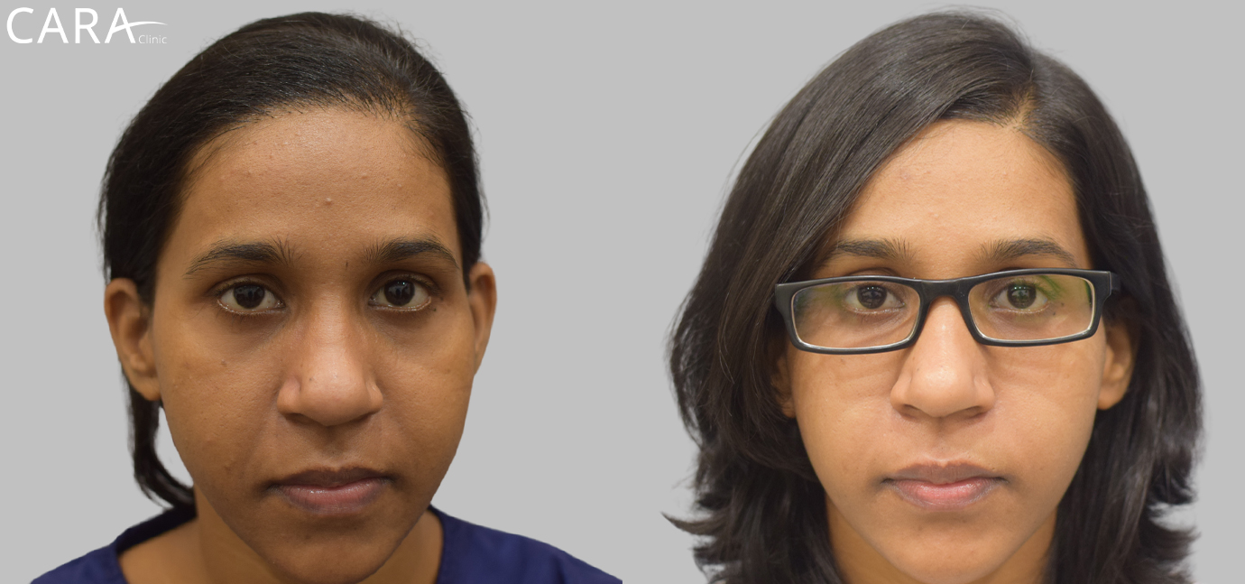 Before and after banner image of a female hair transplant showing significant improvement from thinning hair to a fuller, natural-looking hairline.