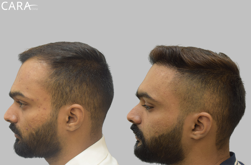 This is the banner image for Hairline Transplant treatment, showing a natural-looking restored hairline