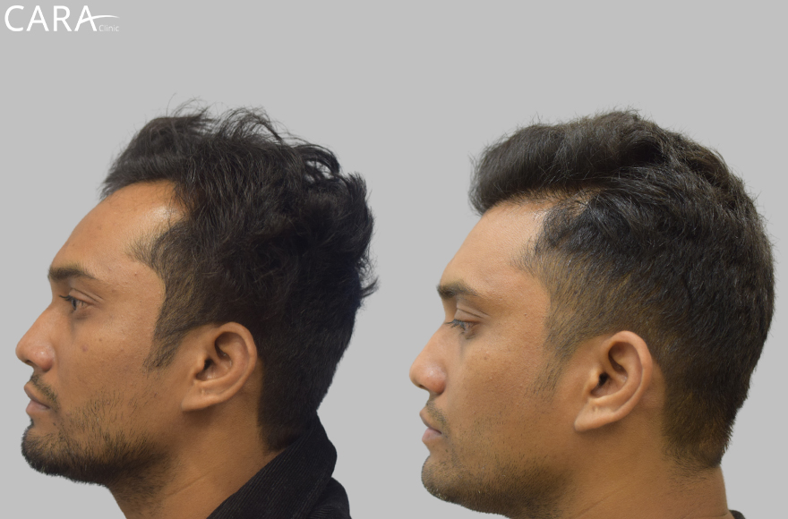 This is the banner image for Hairline Transplant treatment, showing a natural-looking restored hairline