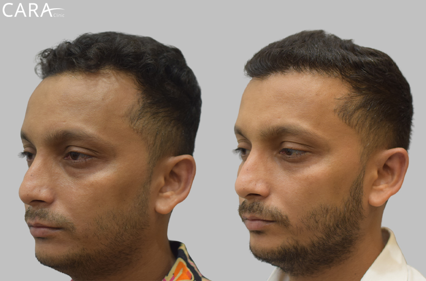 This is the banner image for Hairline Transplant treatment, showing a natural-looking restored hairline