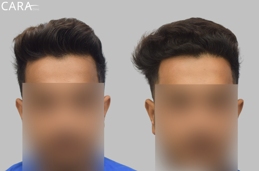 This is the banner image for Hairline Transplant treatment, showing a natural-looking restored hairline