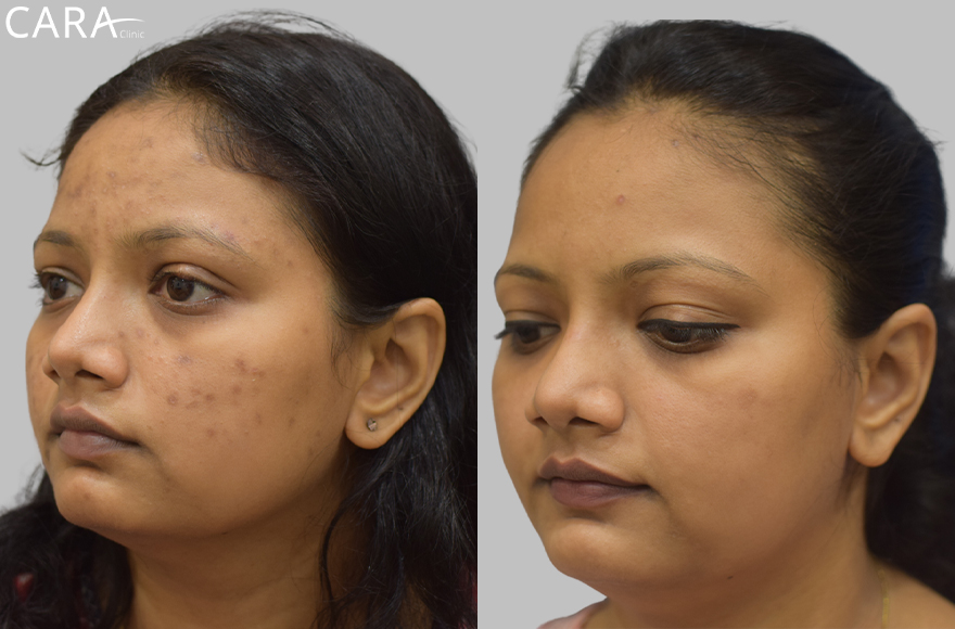 before and after image of female pigmentation treatment image