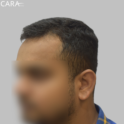 Before Image: Close-up image showing a receding hairline with noticeable thinning along the forehead.