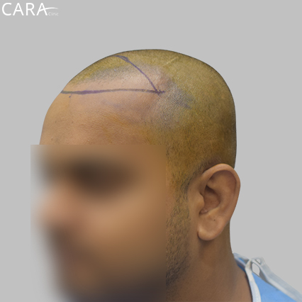 Marking Image: Illustration of the hairline area marked, indicating where transplant grafts are to be placed for optimal coverage and symmetry.