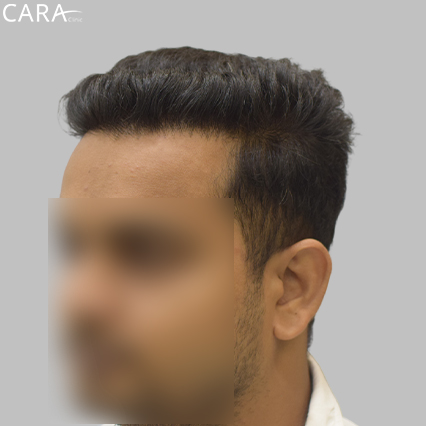 After Image: Image highlighting a fuller, defined hairline with natural hair density post-transplant.