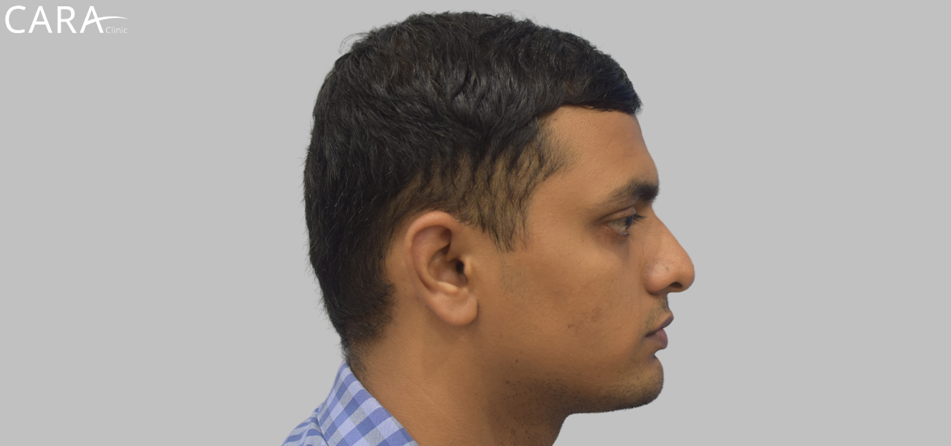 After Male Hair Loss Treatment: "Male patient with full, restored hairline after successful FUE hair transplant treatment at Cara Clinic."